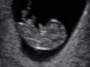 8 week early scan