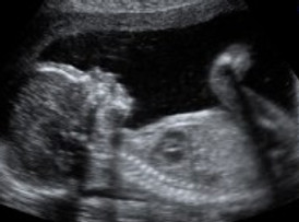 14 week baby sexing scan
