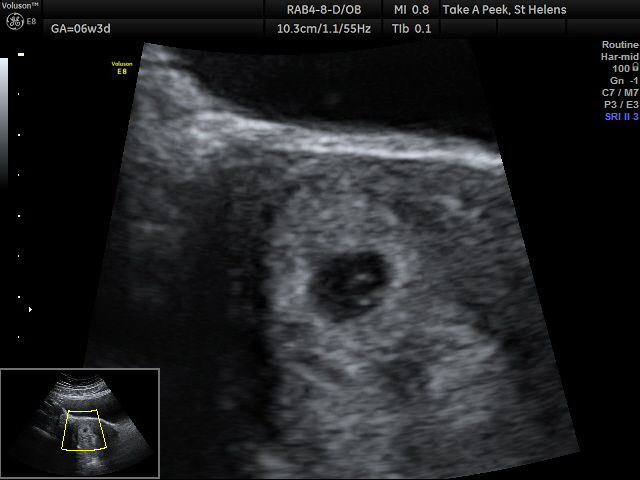 5week pregnancy with yolk sac