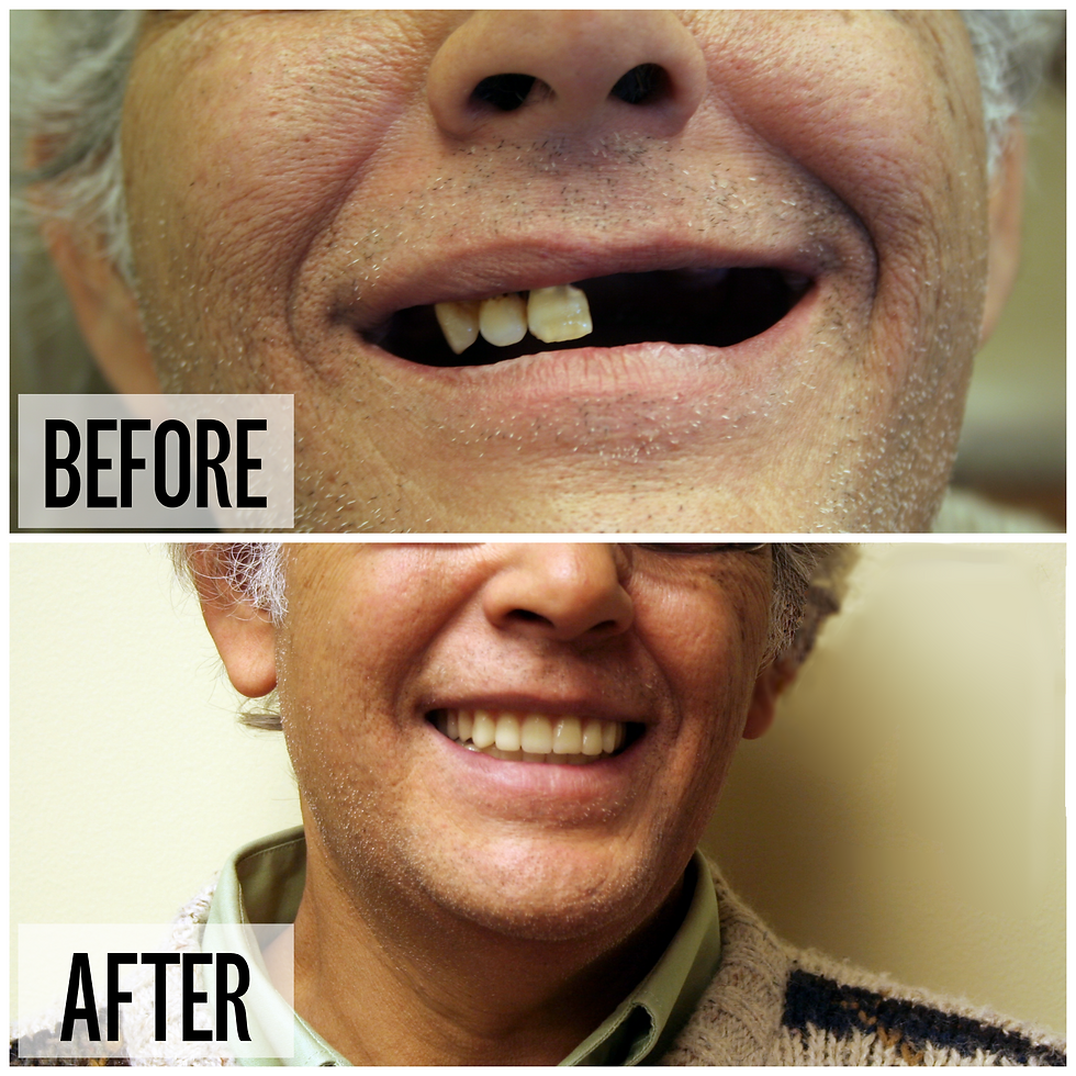 Full Denture