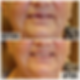 Partial Denture