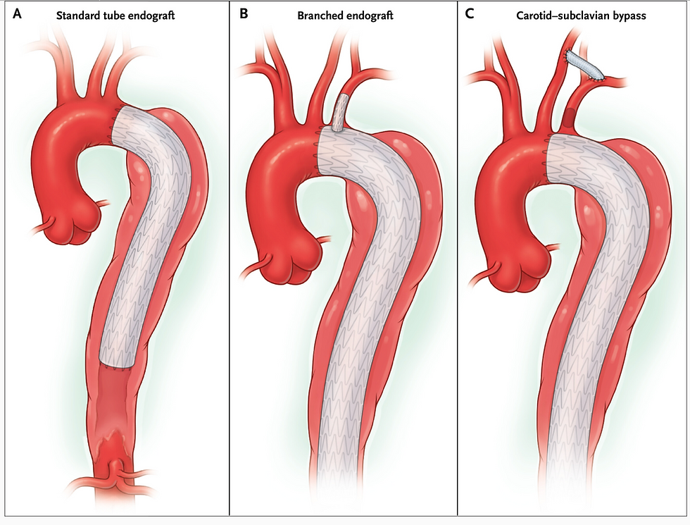 Mussa, F. F., & Kougias, P. (2025). Management of acute type B aortic dissection. The New England Journal of Medicine, 393(9), 895–905. https://doi.org/10.1056/NEJMra2405257