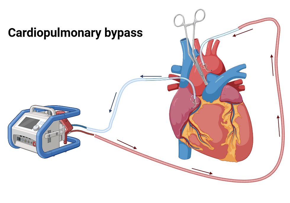 3+Lívia Faria C. Cardiopulmonary bypass in cardiac surgery. Biorender.com n.d. https://www.biorender.com/template/cardiopulmonary-bypass-in-cardiac-surgery (accessed July 21, 2025).