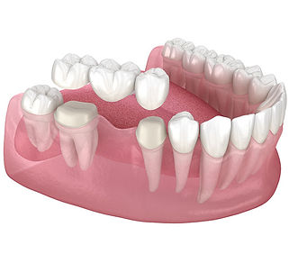 Dental-Bridges