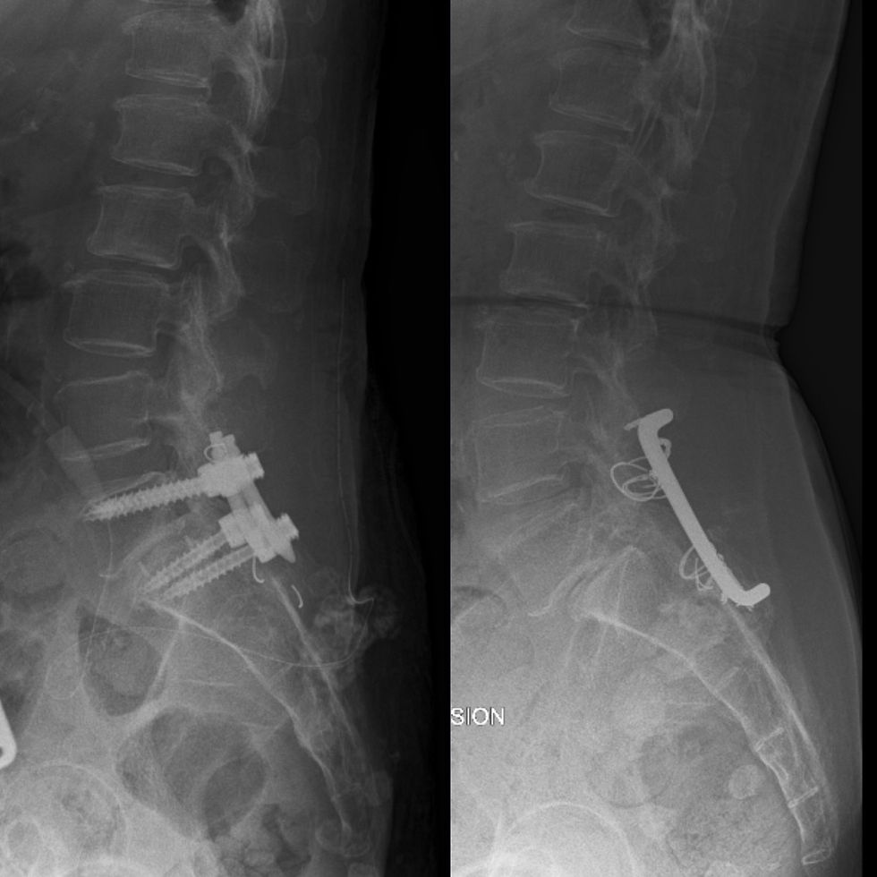 Revision L5/S1 Fusion Surgery