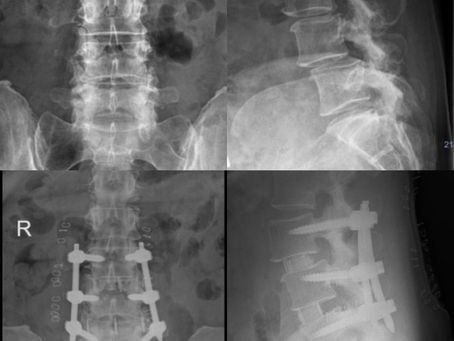 Spondylolisthesis L3/4 and L4/5 (Degenerative Spine Disease)