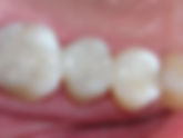 Composite Fillings 