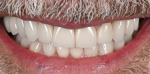 Sigma-zirconia-veneers.png