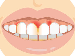 Лечение воспаленных десен