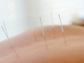 Physical Therapy DRY NEEDLING: An Effective Tool for Pain Relief and Restored Motion