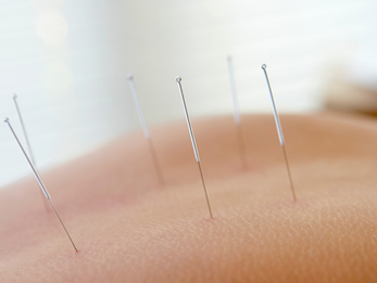 Physical Therapy DRY NEEDLING: An Effective Tool for Pain Relief and Restored Motion