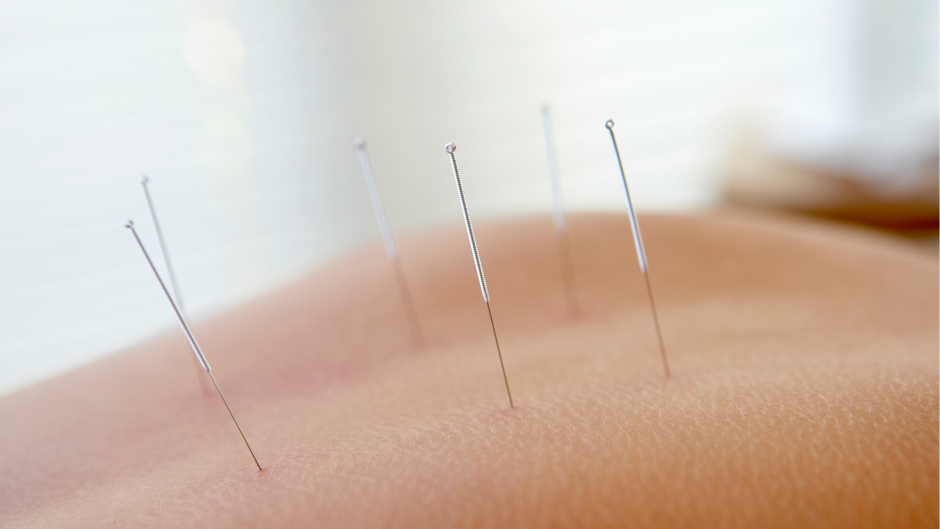 Physical Therapy DRY NEEDLING: An Effective Tool for Pain Relief and Restored Motion