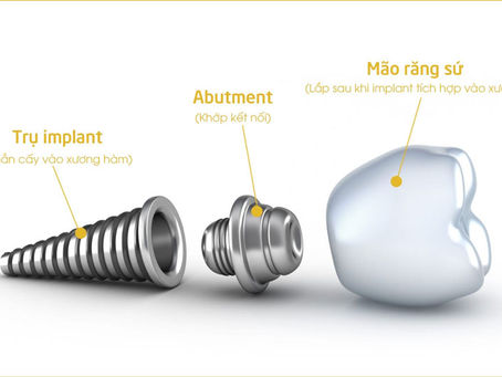 trụ implant mỹ