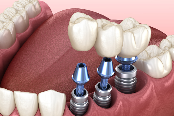 Trồng răng Implant