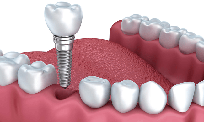 Răng Implant