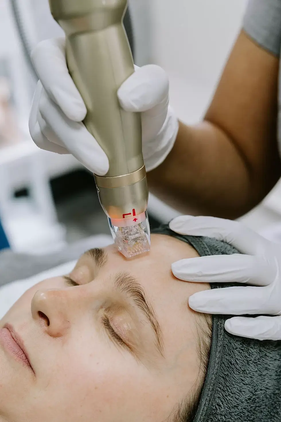 Sylfirm-X-Facial-skin-rejuvenation.webp