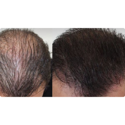scalp Micropigmentation after photos