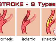 "FAST Action: Recognizing the Signs of Stroke and How to Help"