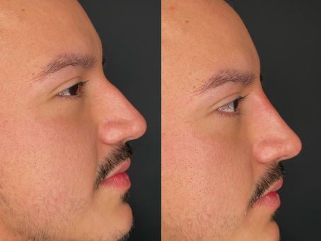 Nose Job Under Ten Minutes: Liquid Rhinoplasty
