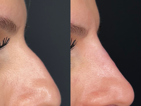 Can Liquid Rhinoplasty Treat Breathing Difficulties Caused by A Deviated Septum?