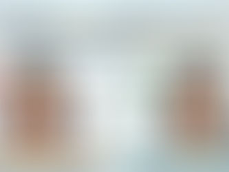 ทลายความเชื่อ "Mewing" จบปัญหาหน้ายาว-คางถอย (Adenoid Face) ด้วยผ่าตัดขากรรไกร