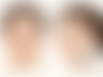 การศัลยกรรมลดความยาวร่องเหนือริมฝีปาก