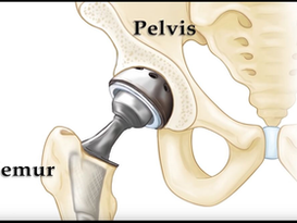Cirugía de reemplazo de cadera: recupere la comodidad y la movilidad
