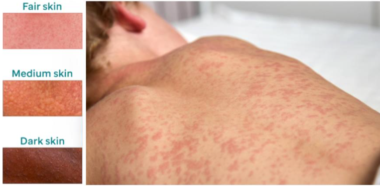 Measles rash across fair, medium, and dark skin tones, with a red, blotchy rash shown on a patient’s back.