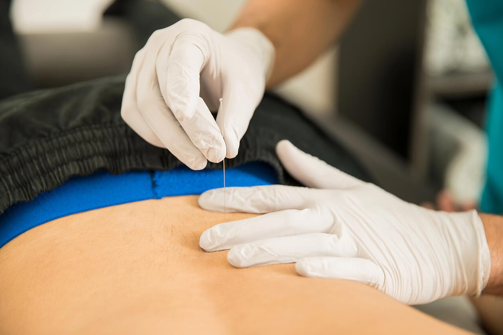Dry needling for sciatica treatment