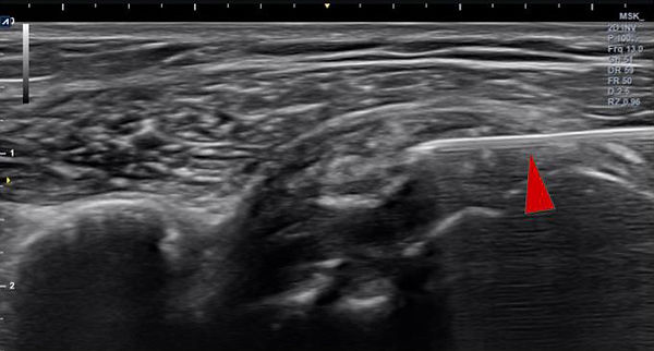 어깨통증 (4).jpg