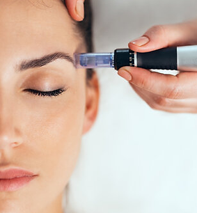 microneedling at Allure in Dubuque, Iowa