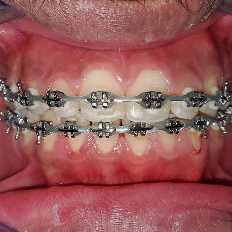 Braces.jpeg