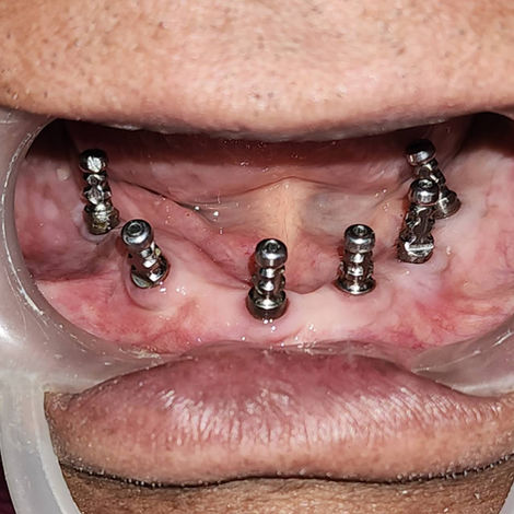 full mouth dental implants.jpeg
