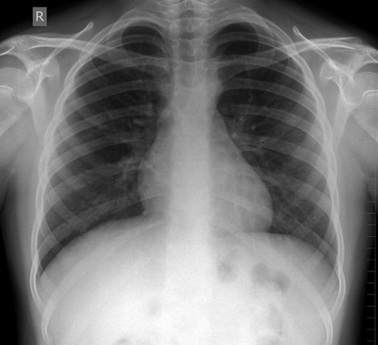 Chest x-ray.jpeg