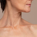 Liposuccion de cuello.jpg