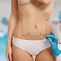 Ninfoplastia.jpg