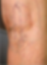 spider vein treatment tucson