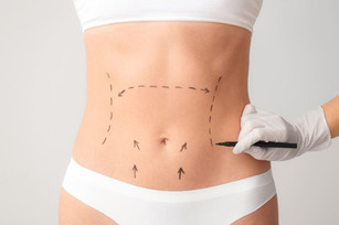 abdominoplastia_P.jpeg