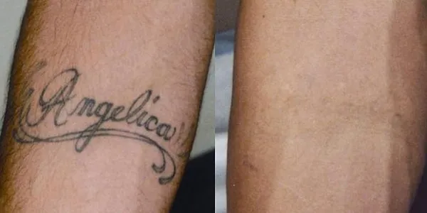 zemits tattoo removal results