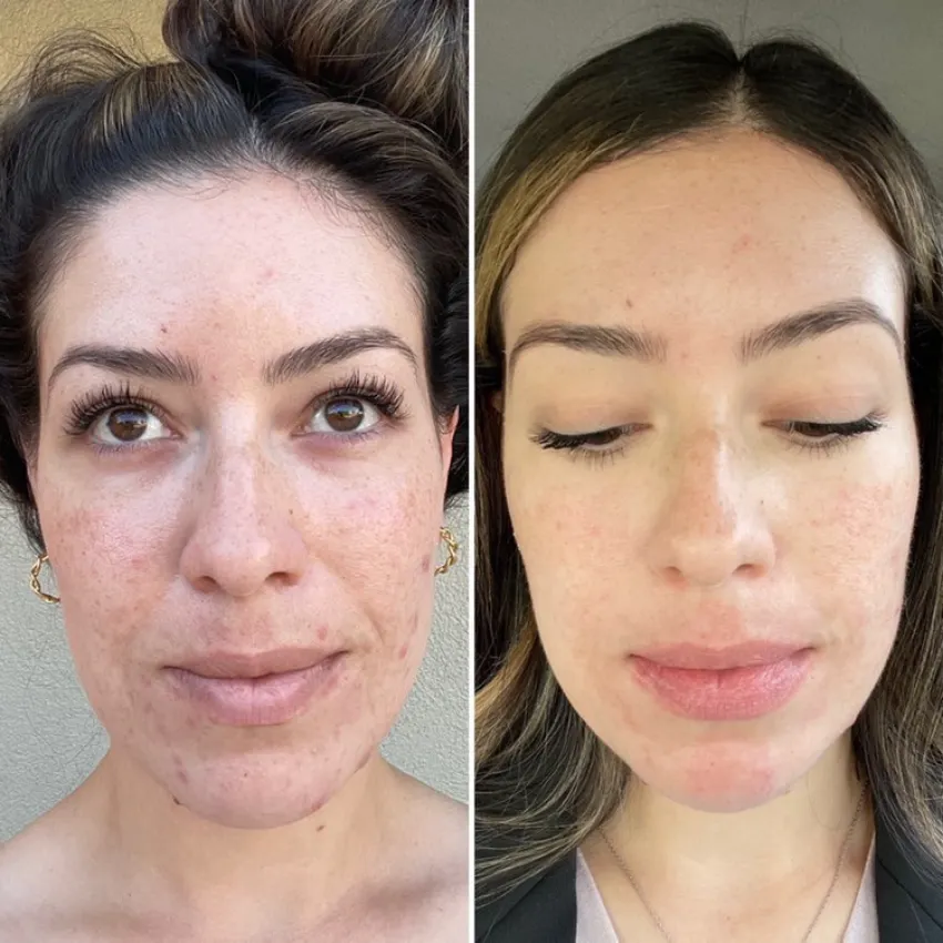 Pen microneedling for skin rejuvenation before and after