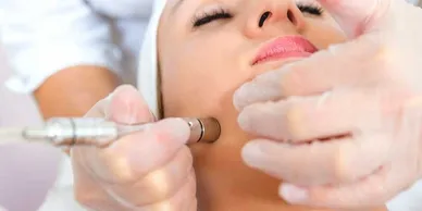 microdermabrasion.webp