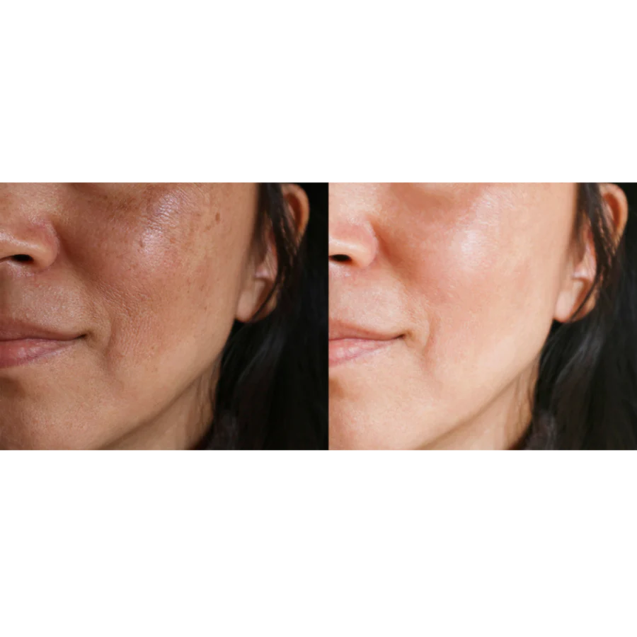 motus ay laser skin resurfacing before and after