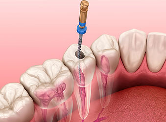 ENDODONTIA-tratamento-de-canal.jpg