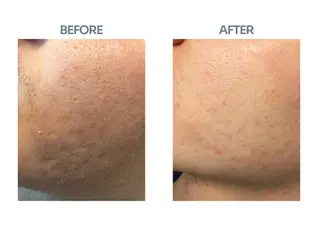 PRX: The Anti-Aging Treatment Explained