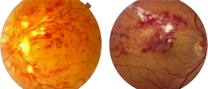 Oclusões-vasculares-da-retina-dra-julia-bastian