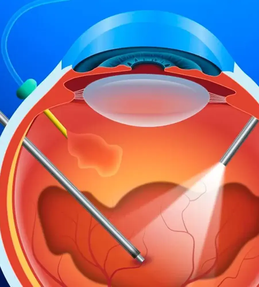 Vitrectomia-cirurgia-imagem-dra-julia-bastian