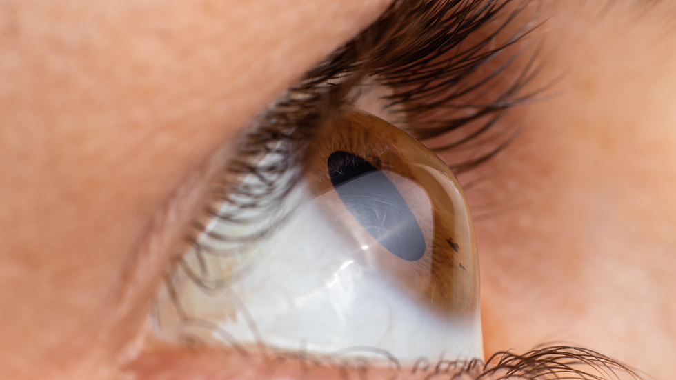 Iris-oftalmologia