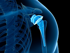 substituição-do-ombro-dr-rogerio-jamil