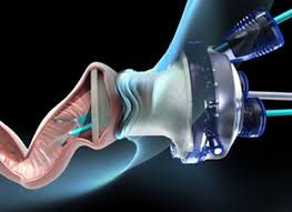 TAMIS (Transanal Minimally Invasive Surgery)