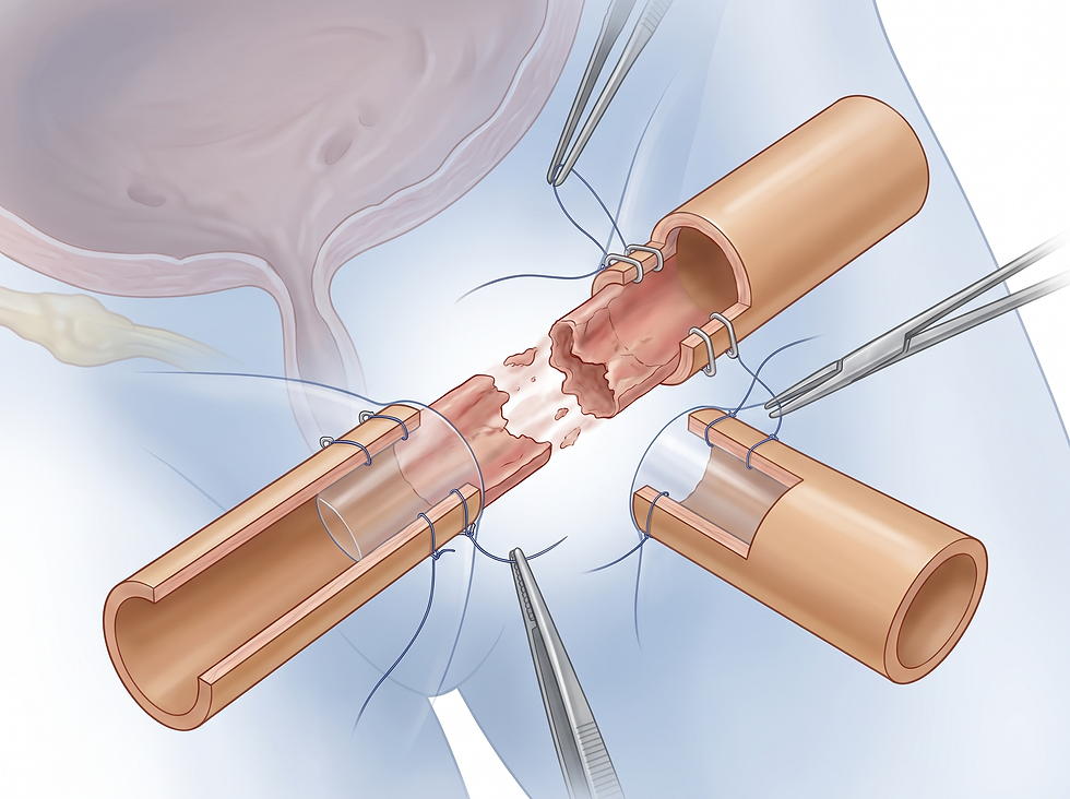 Conceptual view of an anastomotic urethroplasty rejoining healthy urethral ends